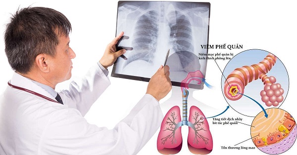 Điều trị bệnh hen và COPD bằng phác đồ khoa học