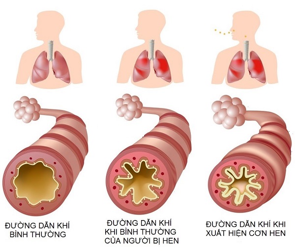 hệ thống hô hấp của bệnh nhân khi bị bệnh