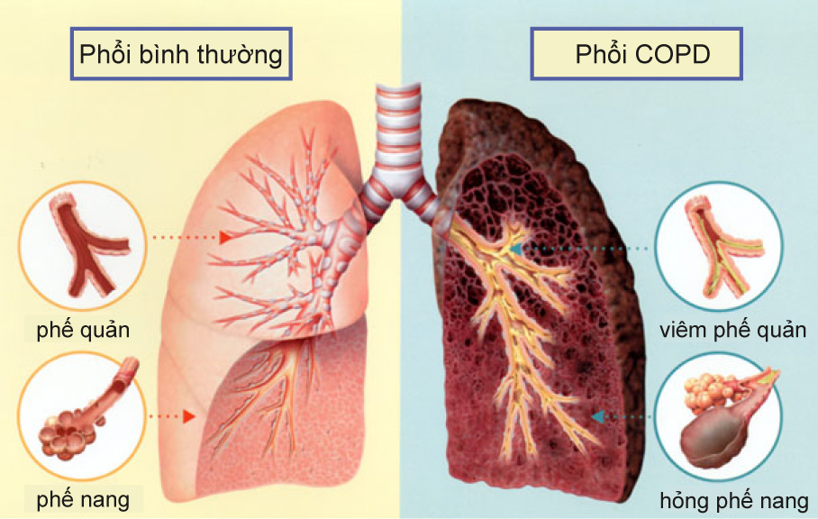 COPD có chữa khỏi được không?